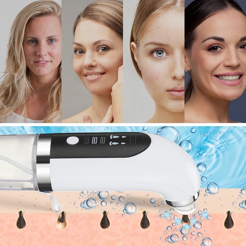 Electric Blackhead Remover Skin Care(Bubble  Water Cycle) Bellezza Soul
